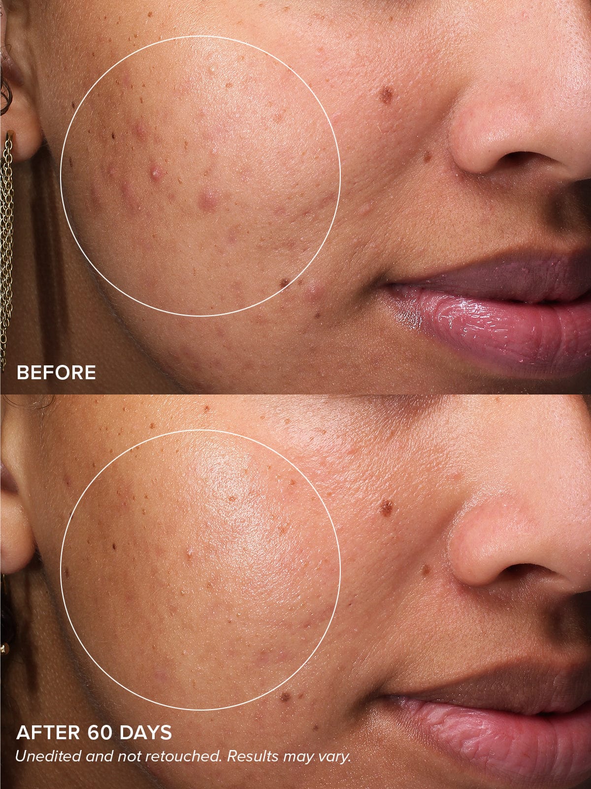 DRMTLGY Gentle Acne Serum Facial Serum for Imperfections with Salicylic Acid 59 ml