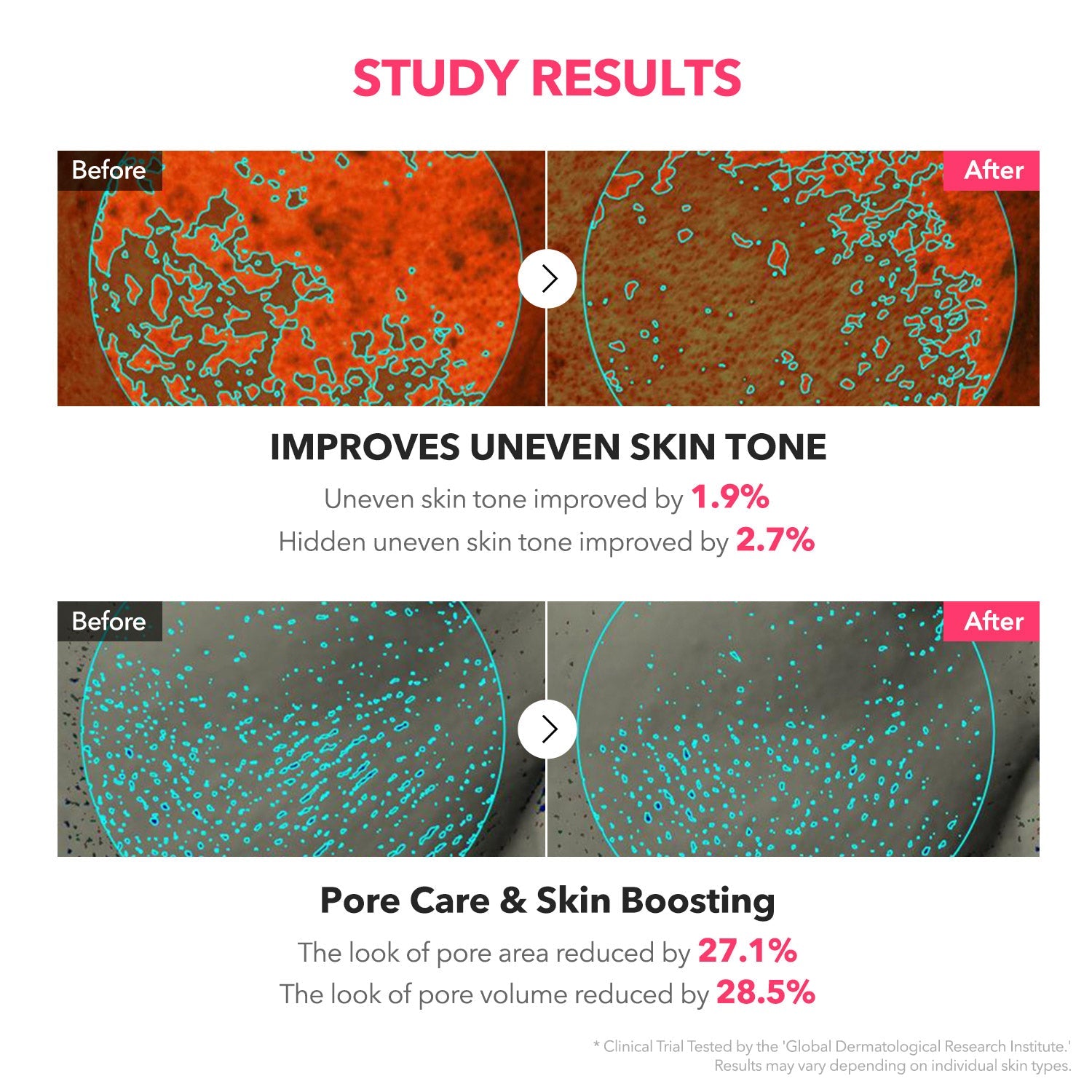 APRILSKIN TXA Niacinamide Toning Shot 99 Spicule Serum - rozjaśniające serum z Tranexamic Acid i technologią Liquid Spicule 30 ml