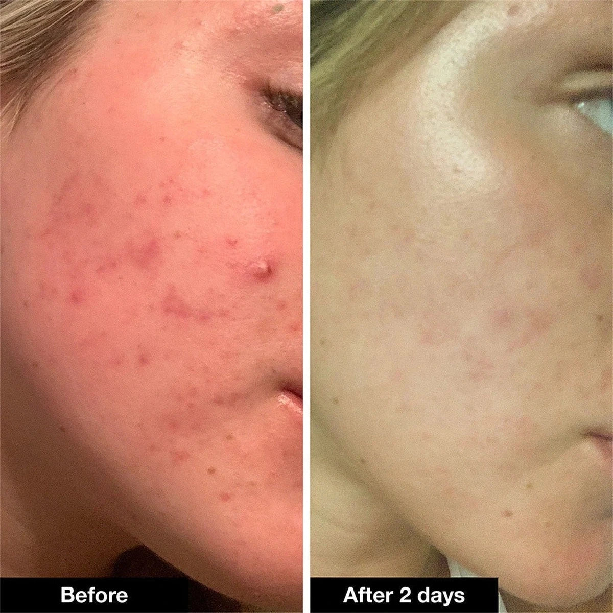 iNNBEAUTY PROJECT Pimple Paste 14.5 g, zestawienie skóry z wypryskami i po nałożeniu | Ellemania