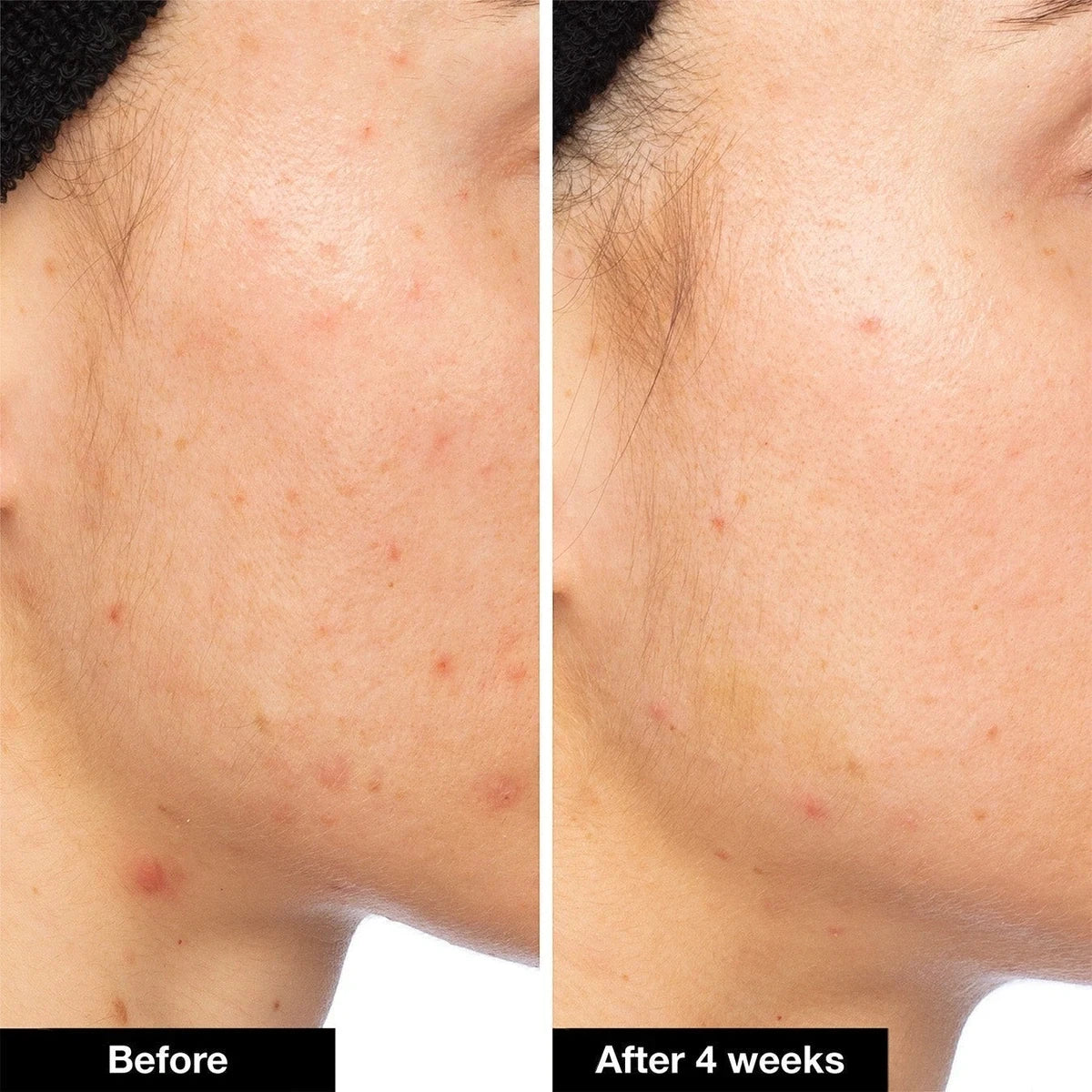 iNNBEAUTY PROJECT Pimple Paste 14,5 g, dwa ujęcia profilu twarzy obok siebie | Ellemania