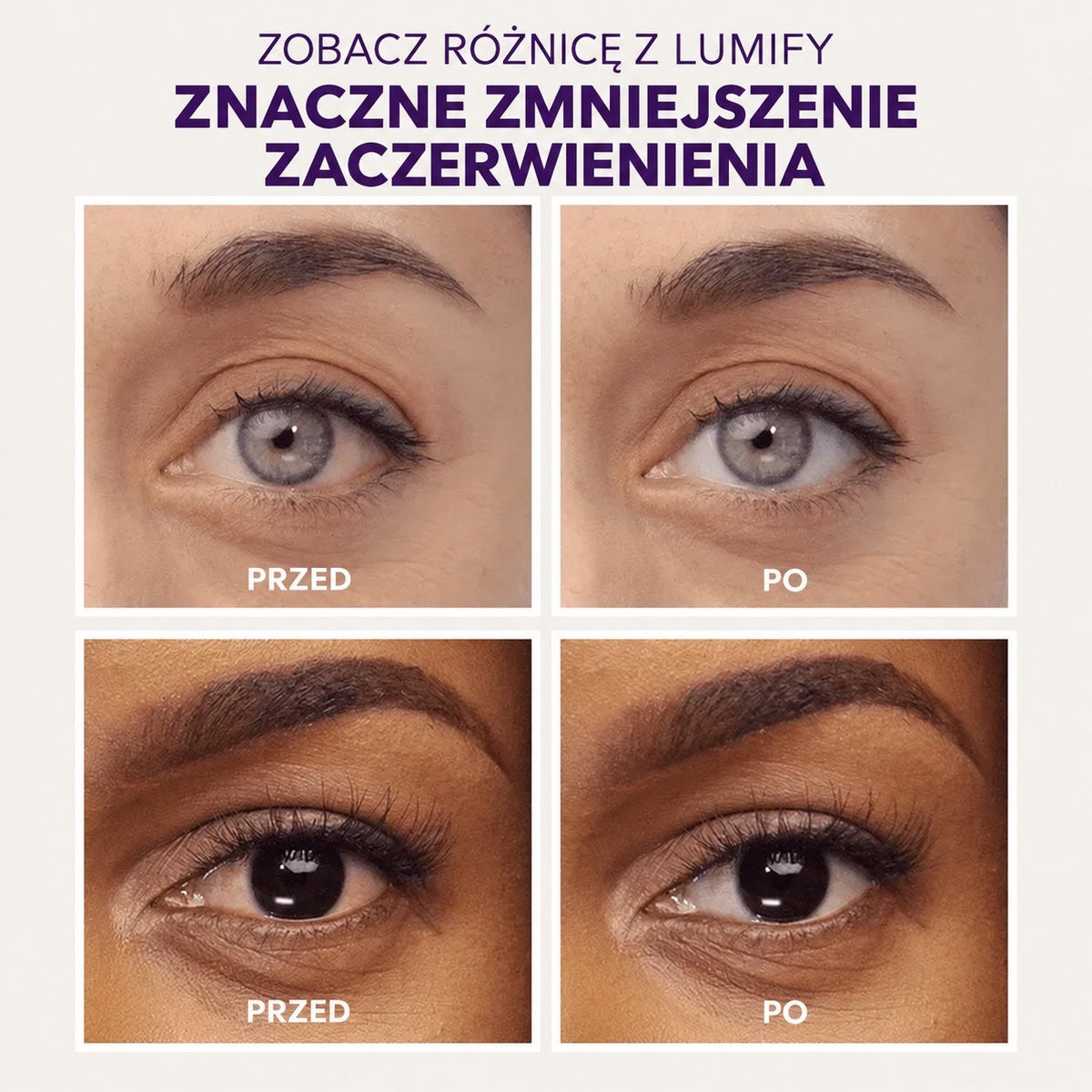 Porównanie efektów stosowania kropli Lumify od ellemania: zdjęcia oczu przed i po użyciu redukującym zaczerwienienie. Lumify Eye Drops to krople do wydobycia pięknej bieli oka. Efekt utrzymuje się aż do 8 godzin. Dodatkowo łagodzą podrażnienia oraz poprawiają blask i wyrazistość oczu.